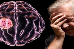 Sức khỏe đời sống - 6 dấu hiệu cảnh báo khối u não rất ít người biết đến