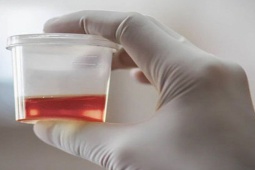 Tiểu ra máu, đau lưng là dấu hiệu cảnh báo sớm loại ung thư này