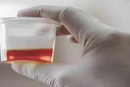 Sức khỏe đời sống - Tiểu ra máu, đau lưng là dấu hiệu cảnh báo sớm loại ung thư này