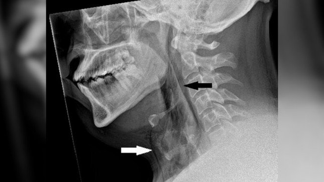 Phim chụp X-quang cổ của người đàn ông cho thấy anh ta có các túi khí mắc kẹt bên dưới da cổ, như được thể hiện qua các mũi tên ở trên. (Ảnh: Báo cáo trường hợp BMJ 2023)