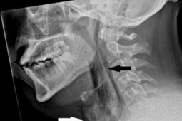 Sức khỏe đời sống - Người đàn ông bị rách khí quản vì nhịn hắt hơi