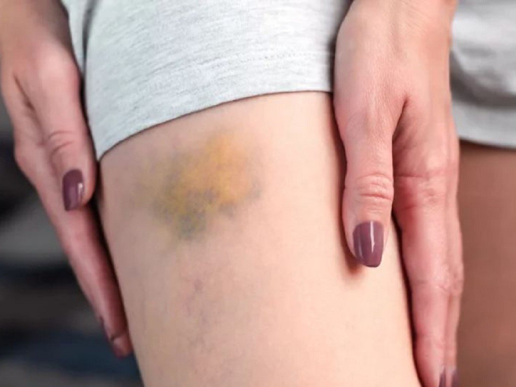 Từ vụ Châu Hải My qua đời, vết bầm tím trên da có thể là dấu hiệu của 7 căn bệnh này - 3