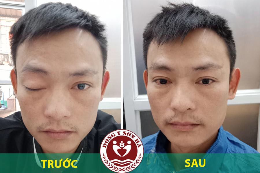 Tại sao liệt dây thần kinh số 3 gây sụp mí mắt? - 4