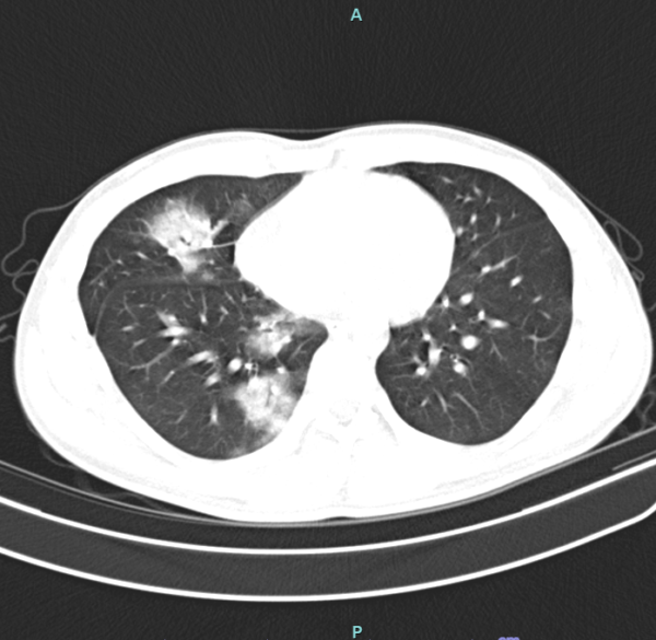 Phim chụp cắt lớp vi tính của người bệnh cho thấy tổn thương thâm nhiễm rộng thùy dưới phổi phải.