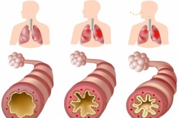 Phòng các cơn hen phế quản khi giao mùa