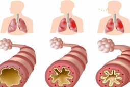 Phòng các cơn hen phế quản khi giao mùa