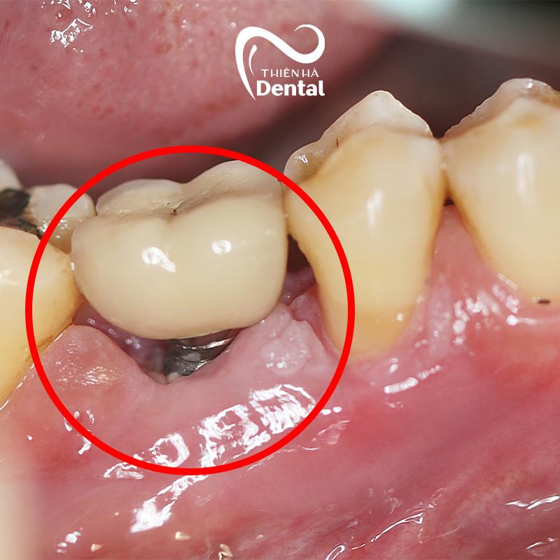 Biến chứng đào thải trụ Implant