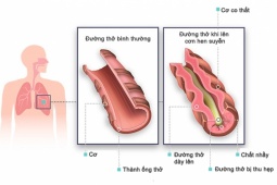 Giải pháp nào để đẩy lùi hen phế quản