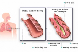 Giải pháp nào để đẩy lùi hen phế quản