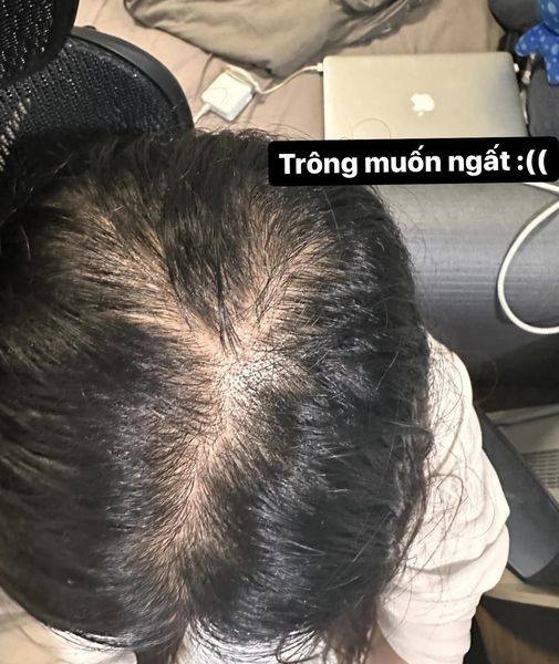 Tóc rụng nhiều, thưa mỏng kèm chân tóc trắng thì là bệnh gì? Giải pháp để kích thích tóc mọc nhanh, chắc khoẻ - 1