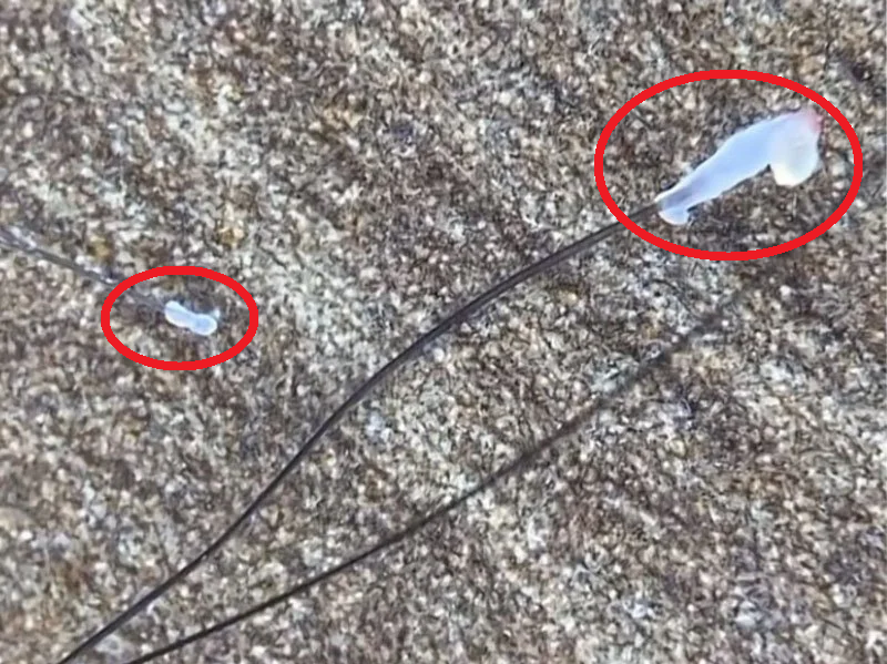 Đây là hình ảnh nang tóc bình thường (ở bên phải) và nang tóc bị rụng do teo nang tóc (bên trái).