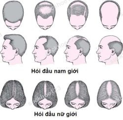 Các dạng hói đầu điển hình ở nam và nữ