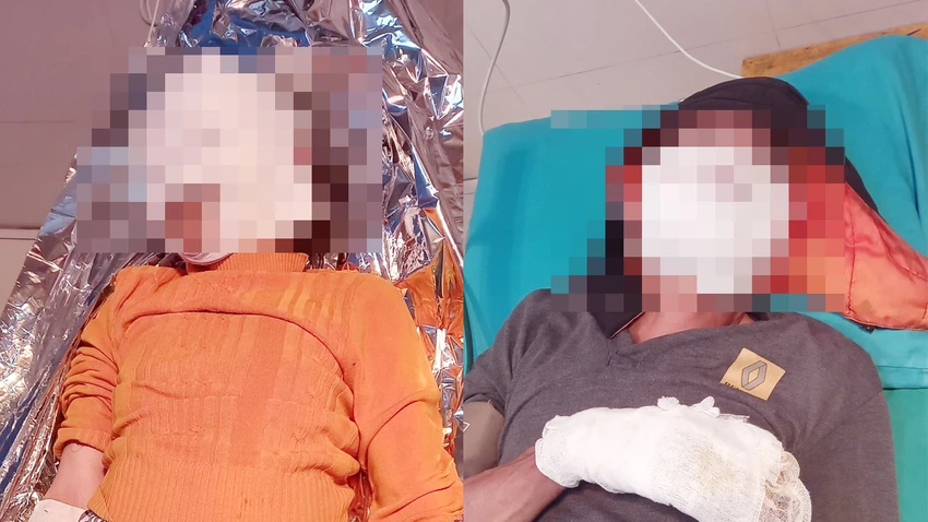 Hai vợ chồng ở Tuyên Quang bị bỏng nặng do điện thoại phát nổ. Ảnh: BVCC