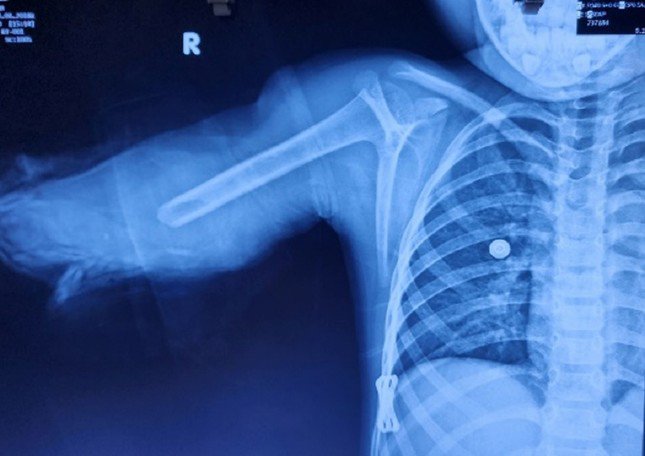 Cánh tay phải của bệnh nhi bị đứt lìa, dập nát phức tạp trên hình ảnh kiểm tra (ảnh: BSCC)