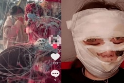 Bạn trẻ - Cuộc sống - Cô dâu suýt "biến dạng" khuôn mặt vì bình xịt dây đám cưới bốc lửa