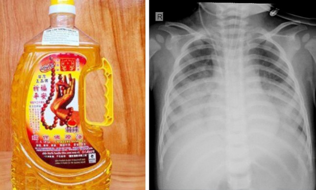 Loại dầu thắp đèn cháu bé uống dẫn đến bị ngộ độc, viêm phổi nặng và trong tình trạng nguy kịch.