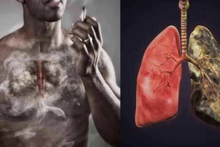 Triệu chứng của ung thư phổi - bệnh ung thư gây tử vong hàng đầu trên...