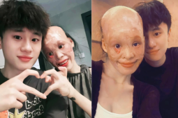 Bạn trẻ - Cuộc sống - Sự thật chuyện cô gái bỏng toàn mặt do cứu mẹ bạn trai