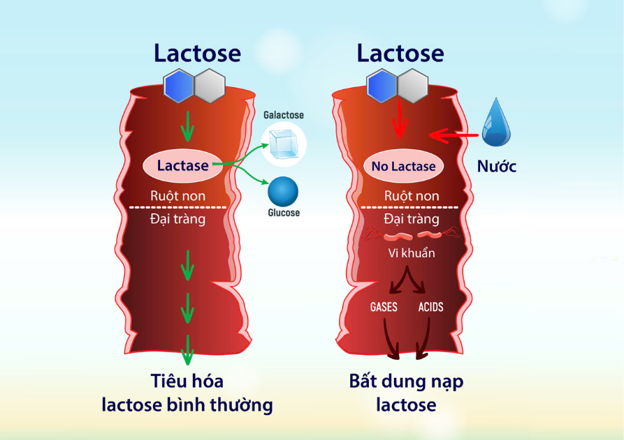 Bất dung nạp lactose xuất hiện do thiếu enzyme lactase&nbsp;