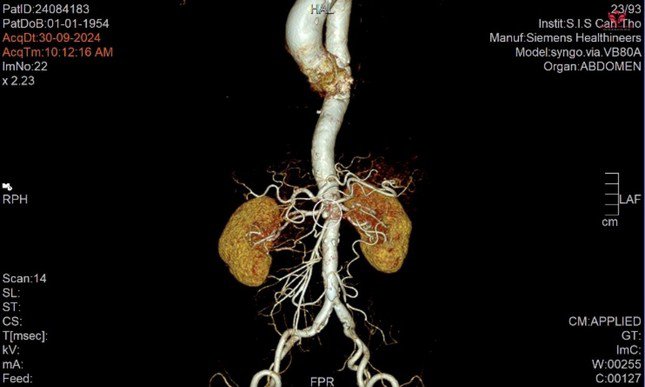 Qua kiểm tra hình ảnh, các bác sĩ phát hiện bệnh nhân bị bóc tách động mạch treo tràng trên