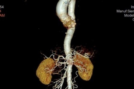 Đau bụng vật vã suốt 3 tuần vì căn bệnh cực hiếm gặp trên toàn thế...