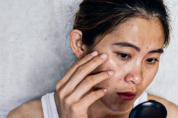 Ba cách dùng gel lô hội trị nám, tàn nhang