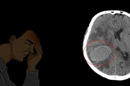 Thấy yếu nửa người, người đàn ông ở Phú Thọ đi khám và bất ngờ phát hiện bị ung thư phổi giai đoạn cuối