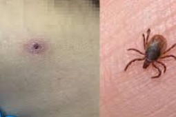 Sức khỏe đời sống - 2 người suy đa tạng, nguy kịch vì căn bệnh nguy hiểm ít người biết