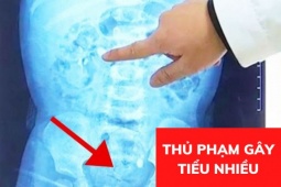 Tin tức sức khỏe - Ai cũng nghĩ đi tiểu ngày hơn 8 lần, đêm 3- 4 lần là bình thường, cho đến khi chuyên gia vạch trần thủ phạm mới vỡ lẽ