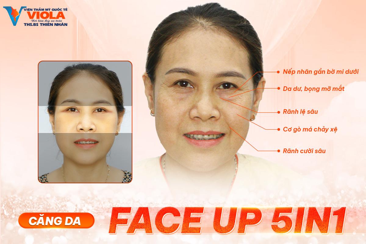 Căng da Face Up 5in1 - Trẻ hóa tầng giữa khuôn mặt