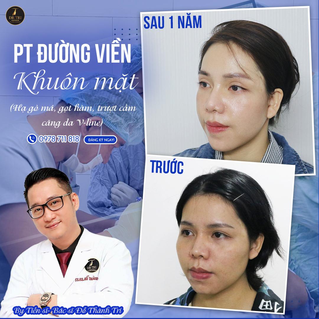 Xu hướng thẩm mỹ mặt V-Line trái xoan với phẫu thuật đường viền khuôn mặt cùng Tiến sĩ, Bác sĩ Đỗ Thành Trí - 3