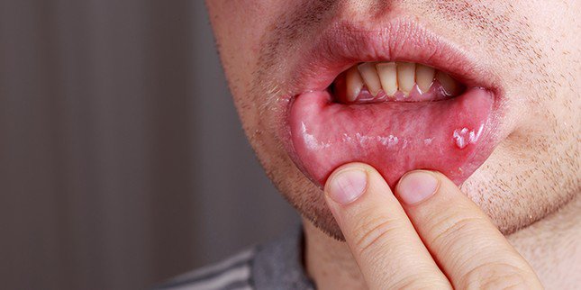 Người nhiễm herpes ở miệng, khu vực sinh dục, trực tràng và hậu môn có thể lây sang người lành qua quan hệ tình dục bằng miệng.