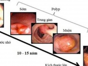 Sức khỏe đời sống - Người đàn ông ở Phú Thọ phát hiện mắc ung thư trực tràng từ một dấu hiệu nhiều người Việt bỏ qua