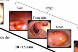 Người đàn ông ở Phú Thọ phát hiện mắc ung thư trực tràng từ một dấu hiệu nhiều người Việt bỏ qua