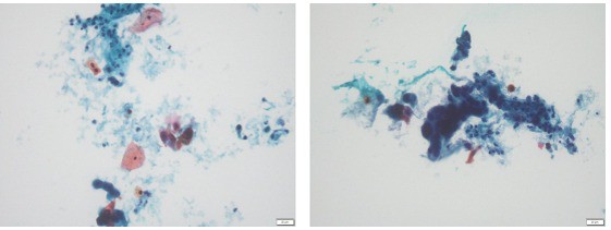 Xét nghiệm phết tế bào cổ tử cung cho thấy sự hiện diện của tế bào ung thư biểu mô vảy