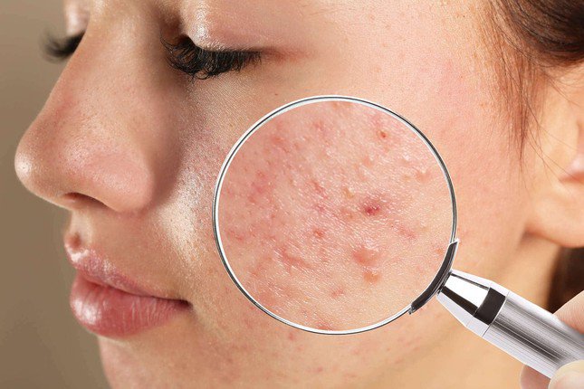 Skincare chăm chỉ nhưng da vẫn nổi mụn, nguyên nhân là do dưỡng ẩm quá đà - 1