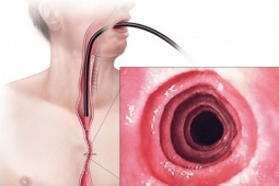 Sức khỏe đời sống - Nam thanh niên bị thủng thực quản sau 1 tháng sụt cân, sốt cao