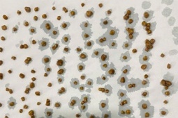 Sức khỏe đời sống - Người phụ nữ 46 tuổi ở Phú Thọ có 172 viên sỏi trong túi mật, cảnh báo thói quen nhiều phụ nữ Việt hay mắc phải