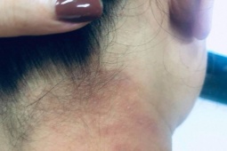 Kiến ba khoang vào mùa, bác sĩ chỉ cách xử trí đúng