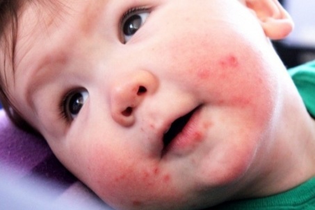 Nhiều trẻ sốt cao, sưng hàm, đi khám phát hiện bệnh nguy hiểm