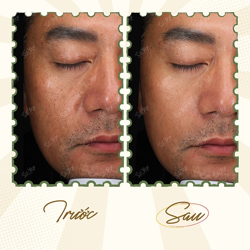 Diễn viên điện ảnh Trương Minh Cường thực hiện dịch vụ Radiesse tại Thế Giới Sắc Đẹp.