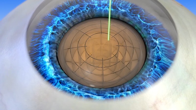 Minh họa phẫu thuật Laser Cataract