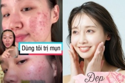 Phương pháp trị mụn bằng tỏi "hot" trên TikTok có thực sự hiệu quả hay hại da? Bác sĩ da liễu chỉ cách làm đúng nhất