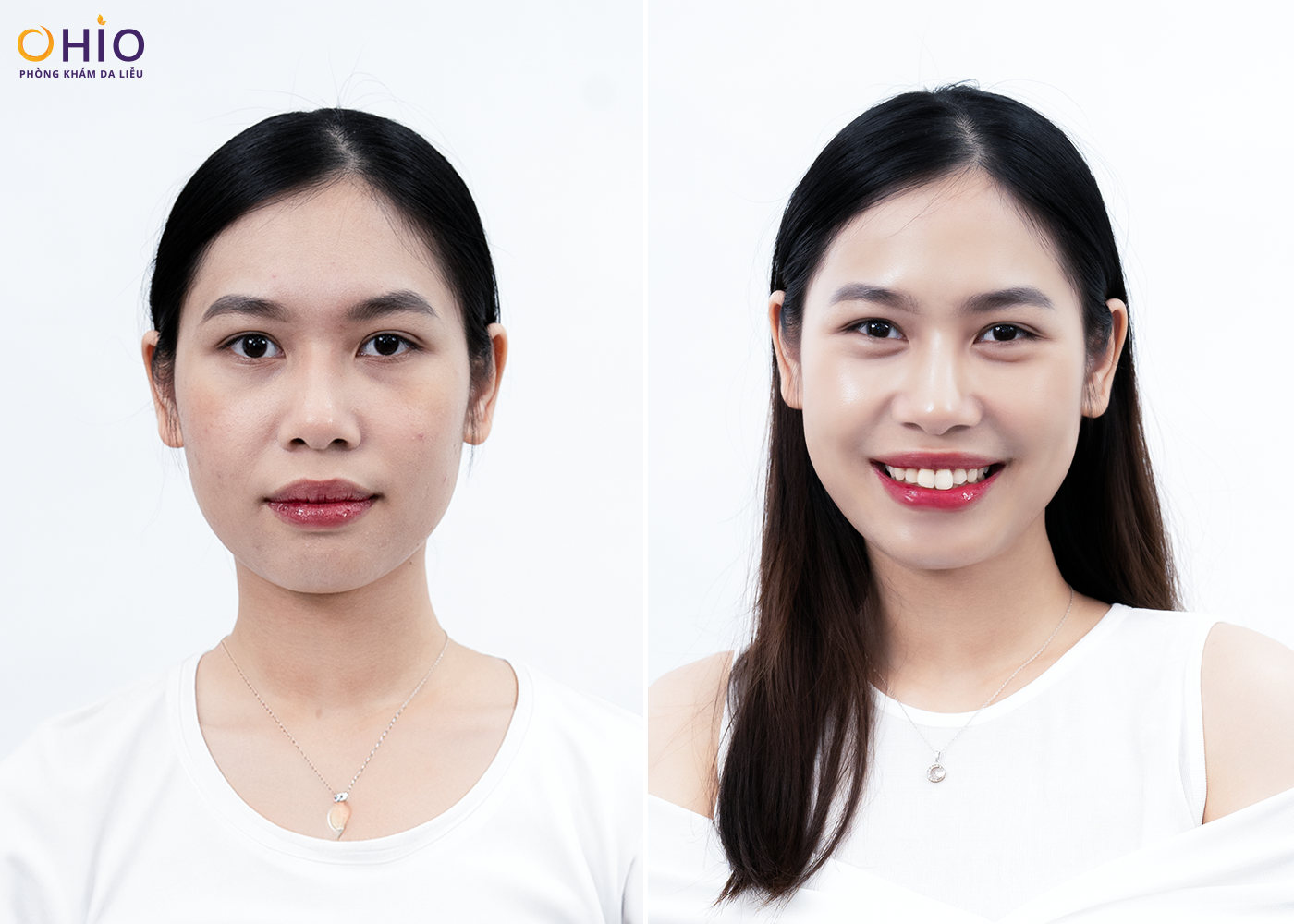 Khách hàng Ngân Hà sau khi thực hiện liệu trình trẻ hóa tại Phòng khám da liễu OHIO