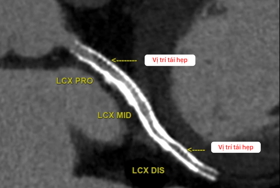 Hình ảnh tái hẹp lòng stent tại động mạch mũ của Bệnh nhân V