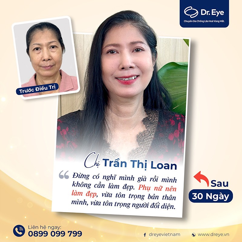 Nâng cung chân mày có để lại sẹo không? Làm sao để an toàn?  - 2