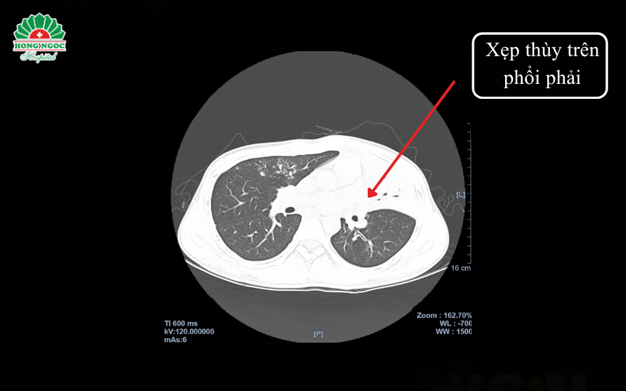 CT 2560 lát cắt cho thấy tình trạng xẹp phổi với nhiều đám tổn thương