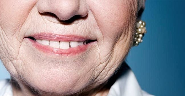 Nếp nhăn trọng lực là loại nếp nhăn khiến gương mặt có xu hướng chảy xệ, da kém săn chắc dần theo thời gian.