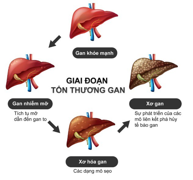 Virus viêm gan B khiến cho gan khỏe mạnh thành xơ gan. Ảnh minh họa