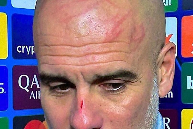 Pep Guardiola tự cào lên mặt sau trận hòa 3-3 trước&nbsp;Feyenoord tại Champions League